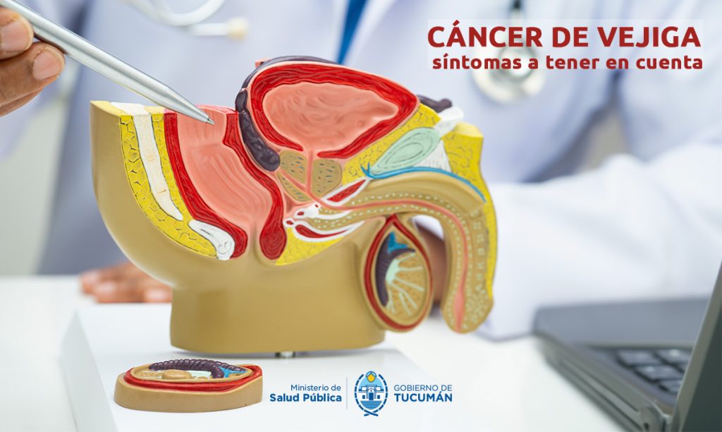 Signos de alerta del cáncer de vejiga